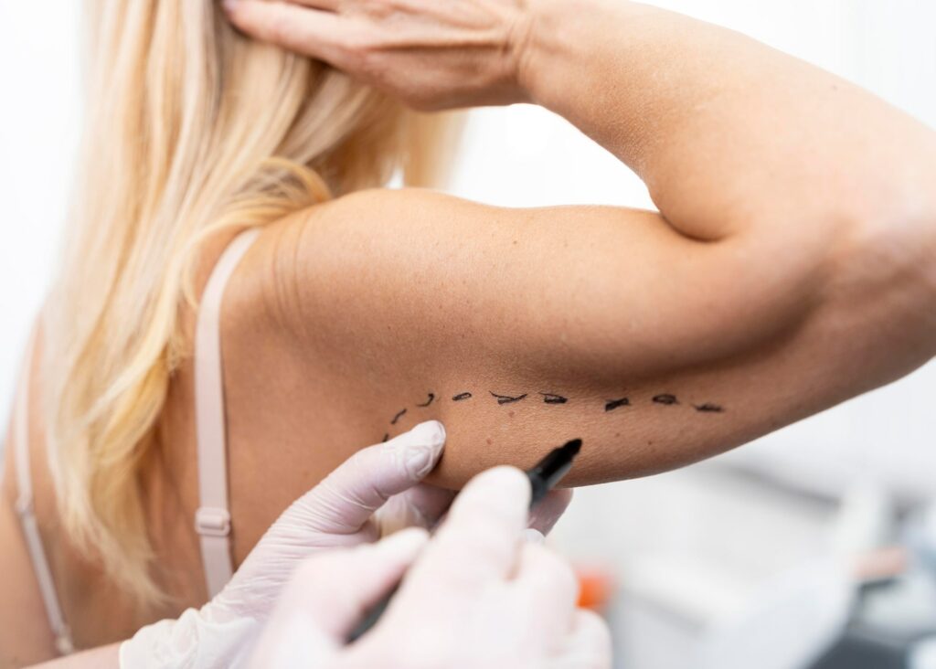 Woman having lines drawn on arm for procedure
