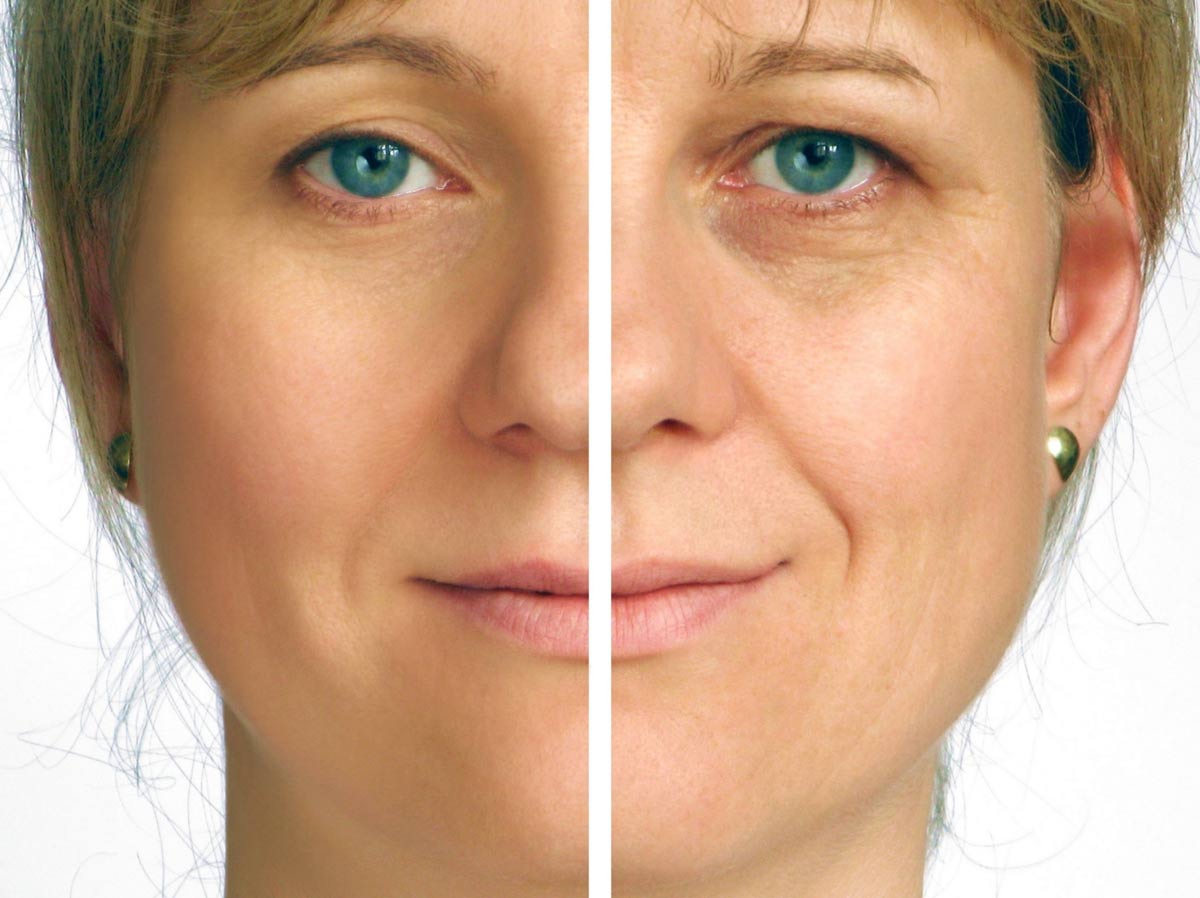 Middle age women with facial volume loss on one side.
