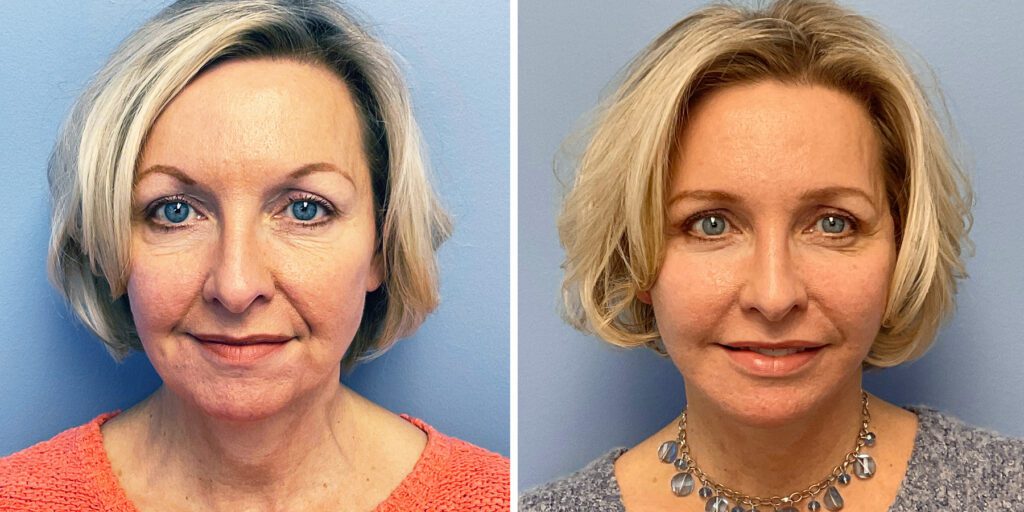 Facelift before & after example