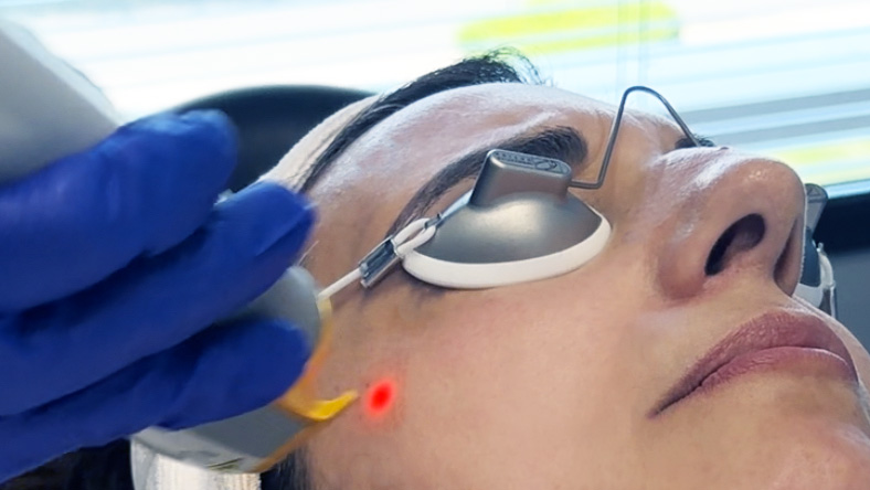 Laser Genesis treatment performed on a patient with safety googles on.