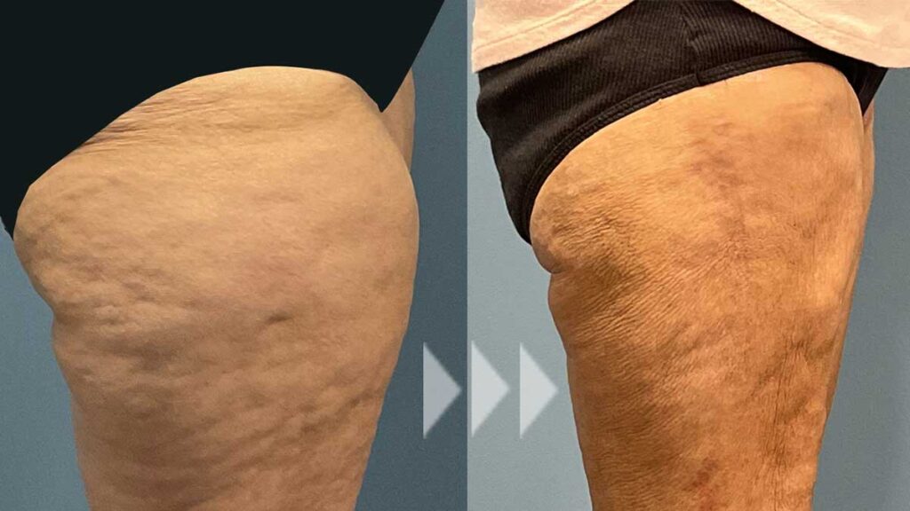Example of before and after treatment for lipedema on upper legs-treatment for painful fat distribution.