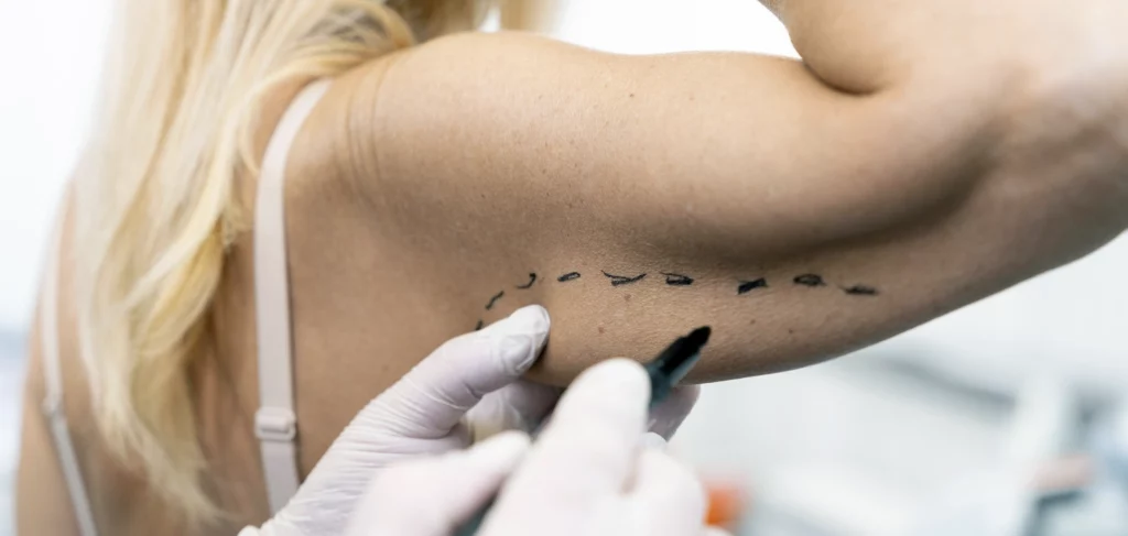 A woman getting ready for an arm lift surgery with surgical marking on the arm