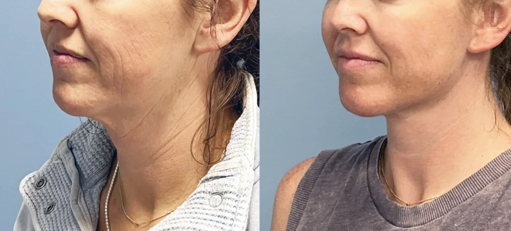 two pictures of a woman in her 40s showing lower facelift result example done in Fairfax VA by plastic surgeon, Dr. Mark Domanski